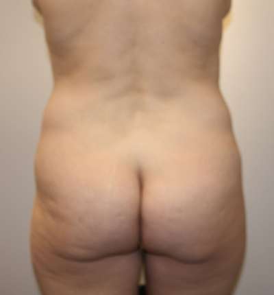 Brazilian Butt Lift for Thinner Patients Before & After Patient #7010