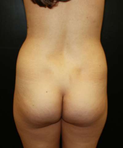 Brazilian Butt Lift for Thinner Patients Before & After Patient #7021
