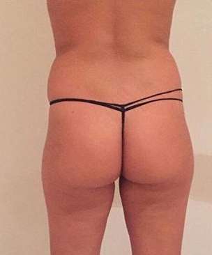 Brazilian Butt Lift for Thinner Patients Before & After Patient #7030