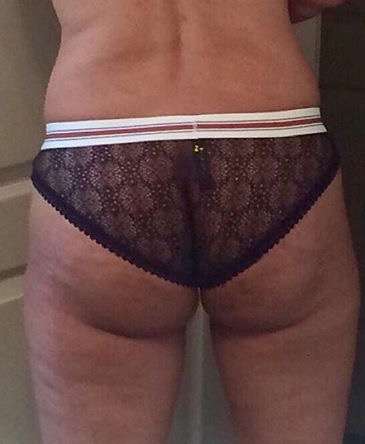 Brazilian Butt Lift for Thinner Patients Before & After Patient #7033