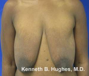 Breast Augmentation and Lift Before & After Patient #7041