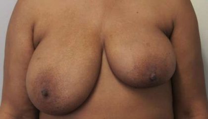 Breast Augmentation and Lift Before & After Patient #7044