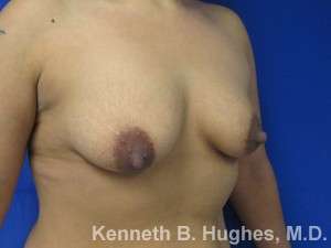 Breast Augmentation and Lift Before & After Patient #7057