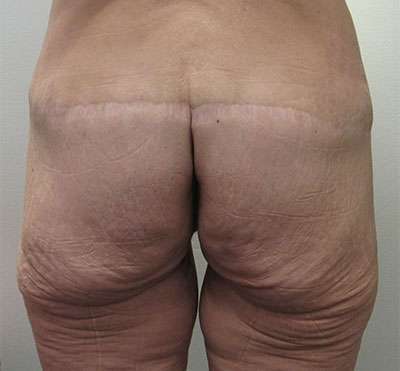 Body Lift Before & After Patient #5966