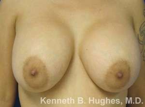 Breast Augmentation and Lift Before & After Patient #7073