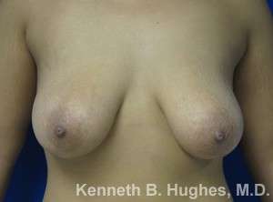Breast Augmentation and Lift Before & After Patient #7079