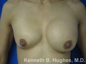 Breast Augmentation and Lift Before & After Patient #7082