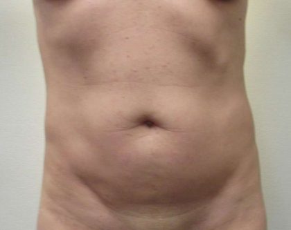 Abdomen Before & After Patient #5852