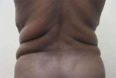 Body Lift Before & After Patient #5969