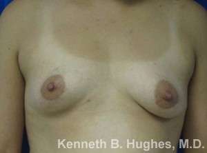 Breast Augmentation and Lift Before & After Patient #7094