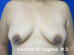 Breast Augmentation and Lift Before & After Patient #7100