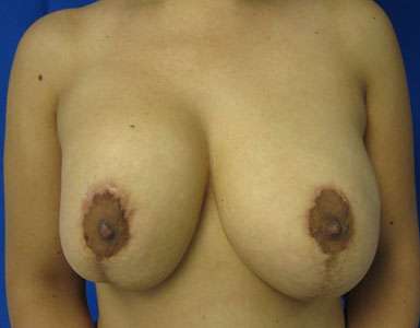 Breast Augmentation and Lift Before & After Patient #7103
