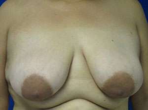 Breast Augmentation and Lift Before & After Patient #7109