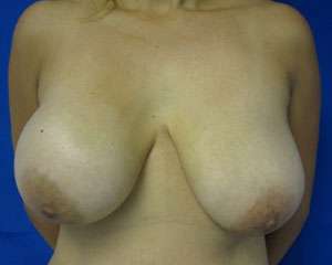Breast Augmentation and Lift Before & After Patient #7115