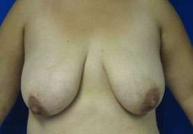 Breast Augmentation and Lift Before & After Patient #7118