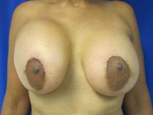 Breast Augmentation and Lift Before & After Patient #7121