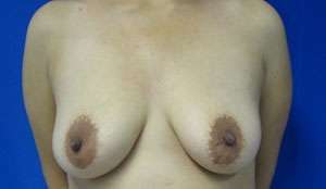 Breast Augmentation and Lift Before & After Patient #7124