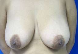 Breast Augmentation and Lift Before & After Patient #7127