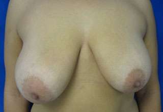Breast Augmentation and Lift Before & After Patient #7133