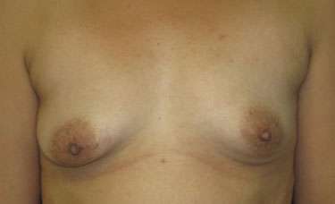 Breast Augmentation and Lift Before & After Patient #7136