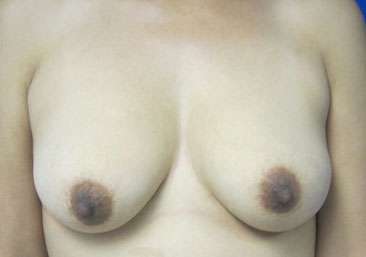 Breast Augmentation and Lift Before & After Patient #7139