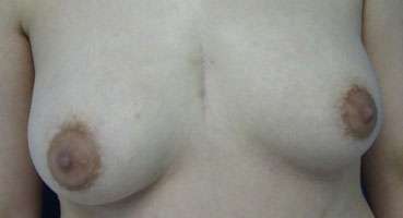 Breast Augmentation and Lift Before & After Patient #7142