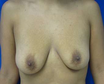 Breast Augmentation and Lift Before & After Patient #7148