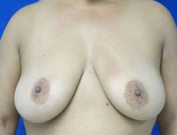 Breast Augmentation and Lift Before & After Patient #7151