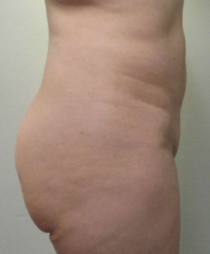 Body Lift Before & After Patient #5975