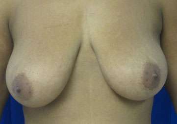 Breast Augmentation and Lift Before & After Patient #7154