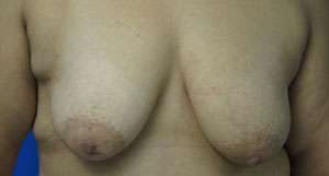 Breast Augmentation and Lift Before & After Patient #7157