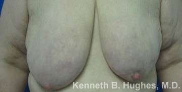 Breast Augmentation and Lift Before & After Patient #7167