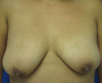 Breast Augmentation and Lift Before & After Patient #7170