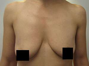 Breast Augmentation and Lift Before & After Patient #7177