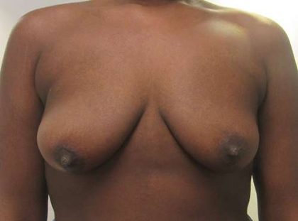 Breast Augmentation and Lift Before & After Patient #7184