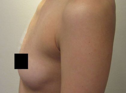 Breast Augmentation Implants Before & After Patient #7194