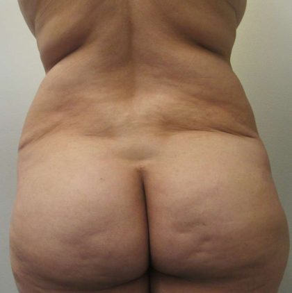 Body Lift Before & After Patient #5982