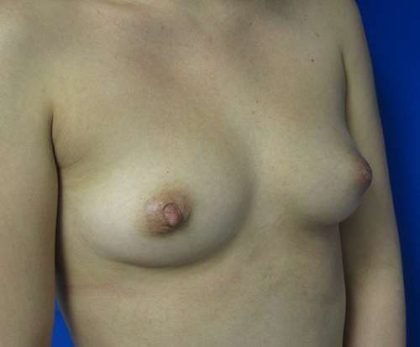 Breast Augmentation Implants Before & After Patient #7202
