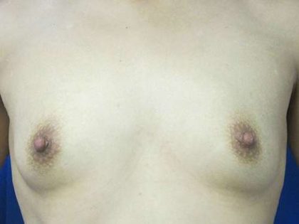 Breast Augmentation Implants Before & After Patient #7205