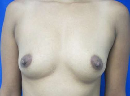 Breast Augmentation Implants Before & After Patient #7208