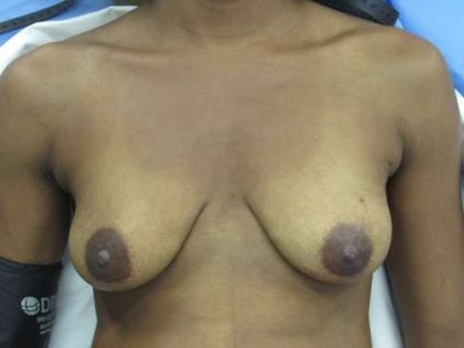 Breast Augmentation Implants Before & After Patient #7211