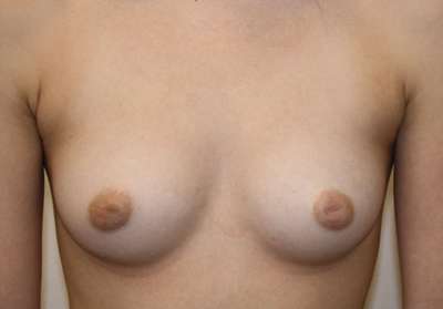Breast Augmentation Implants Before & After Patient #7214