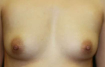 Breast Augmentation Implants Before & After Patient #7217