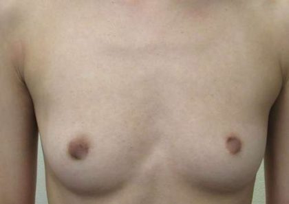 Breast Augmentation Implants Before & After Patient #7220