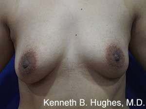 Breast Augmentation Implants Before & After Patient #7223