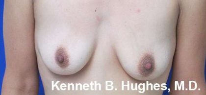 Breast Augmentation Implants Before & After Patient #7226