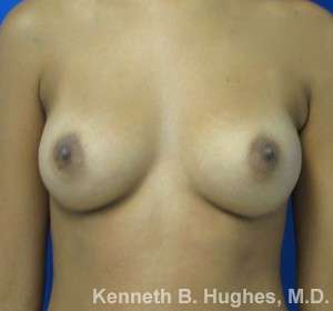 Breast Augmentation Implants Before & After Patient #7229