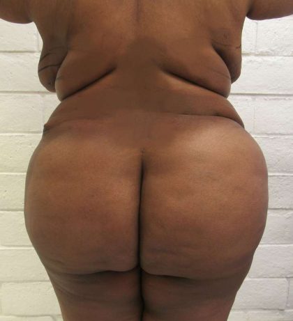 Body Lift Before & After Patient #5985