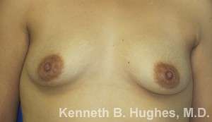 Breast Augmentation Implants Before & After Patient #7236