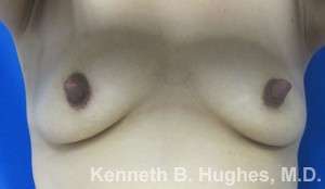 Breast Augmentation Implants Before & After Patient #7239